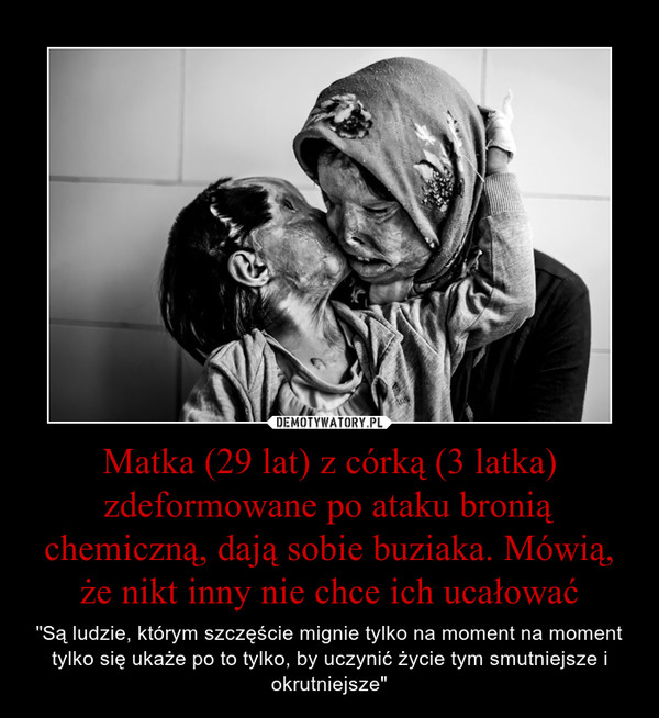 Matka (29 lat) z córką (3 latka) zdeformowane po ataku bronią chemiczną, dają sobie buziaka. Mówią, że nikt inny nie chce ich ucałować