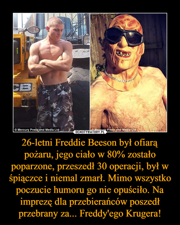 26-letni Freddie Beeson był ofiarą pożaru, jego ciało w 80% zostało poparzone, przeszedł 30 operacji, był w śpiączce i niemal zmarł. Mimo wszystko poczucie humoru go nie opuściło. Na imprezę dla przebierańców poszedł przebrany za... Freddy'ego Krugera! –  