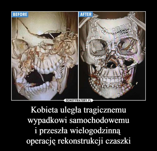 Kobieta uległa tragicznemuwypadkowi samochodowemui przeszła wielogodzinną operację rekonstrukcji czaszki –  