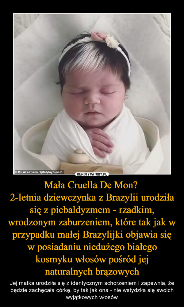Mała Cruella De Mon? 2-letnia dziewczynka z Brazylii urodziła się z piebaldyzmem - rzadkim, wrodzonym zaburzeniem, które tak jak w przypadku małej Brazylijki objawia się w posiadaniu niedużego białego kosmyku włosów pośród jejnaturalnych brązowych – Jej matka urodziła się z identycznym schorzeniem i zapewnia, że będzie zachęcała córkę, by tak jak ona - nie wstydziła się swoich wyjątkowych włosów 
